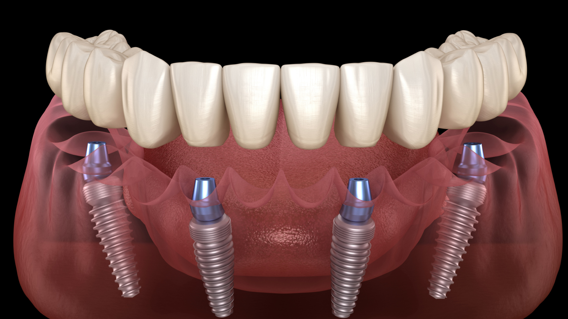 All-on-4 retained fixed dentures